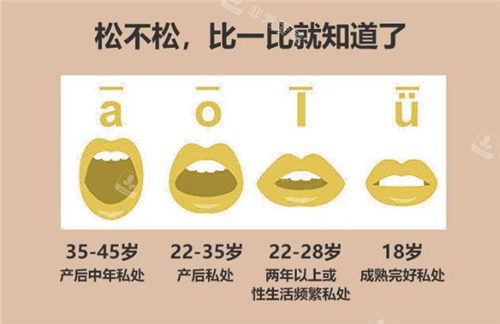 VR彩票蝴蝶型和馒头型的区别图女性生殖蝴蝶唇(图1)